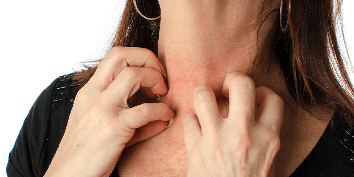 Toczeń rumieniowaty układowy