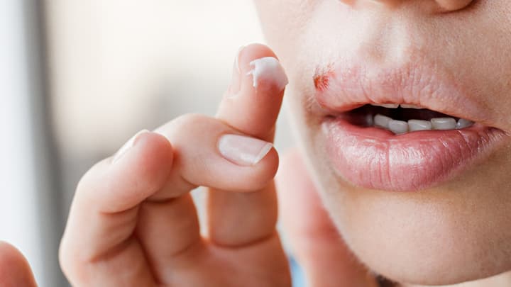 żółta febra objawy