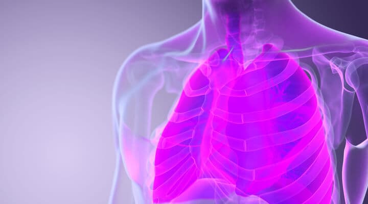 zachłystowe zapalenie płuc