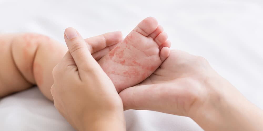 płonica, szkarlatyna