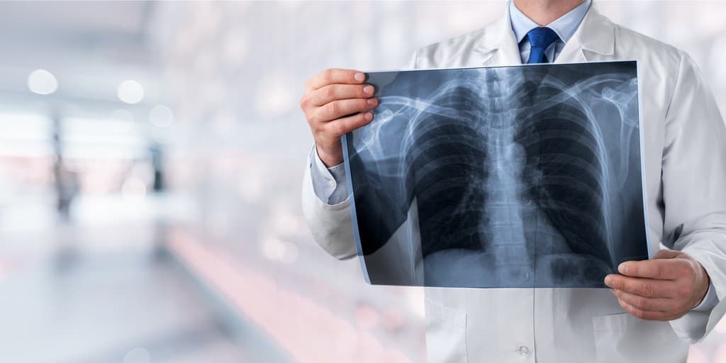 Atypowe zapalenie płuc