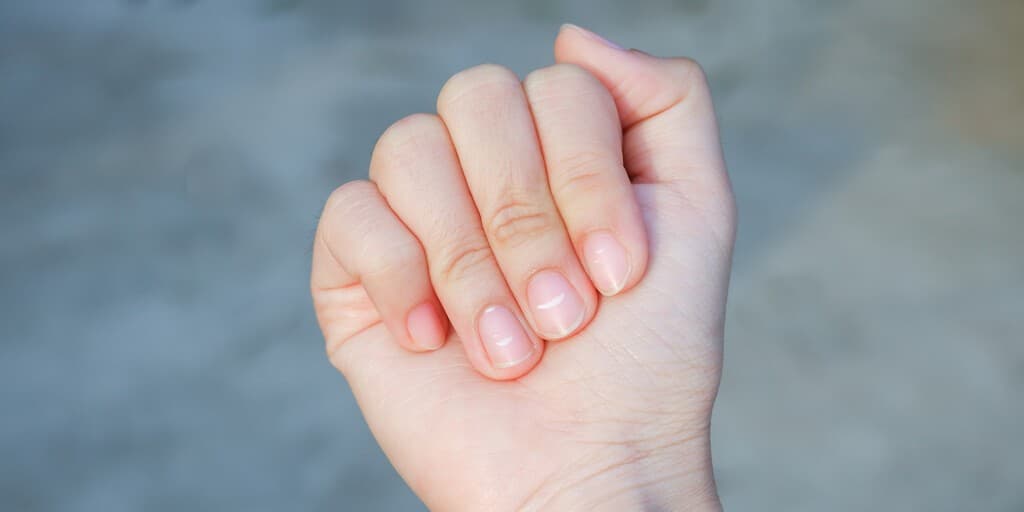 Hiperkeratoza podpaznokciowa