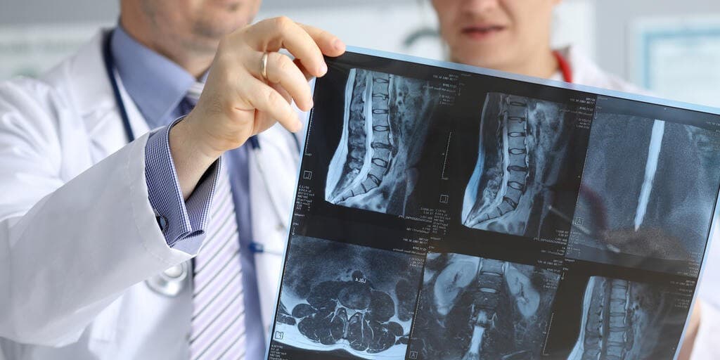 Oponiak kręgosłupa