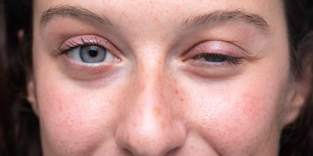 Dystrofia czopkowo-pręcikowa