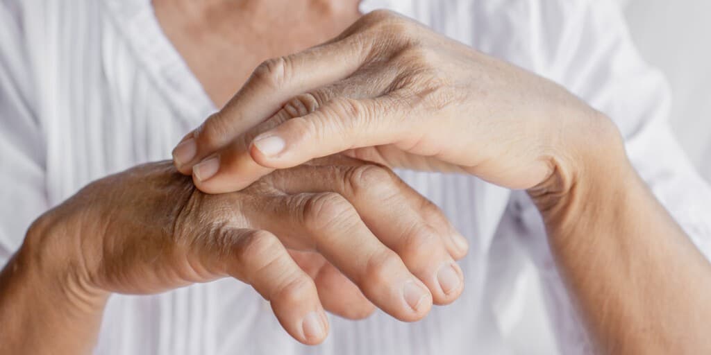 Opuchnięte dłonie