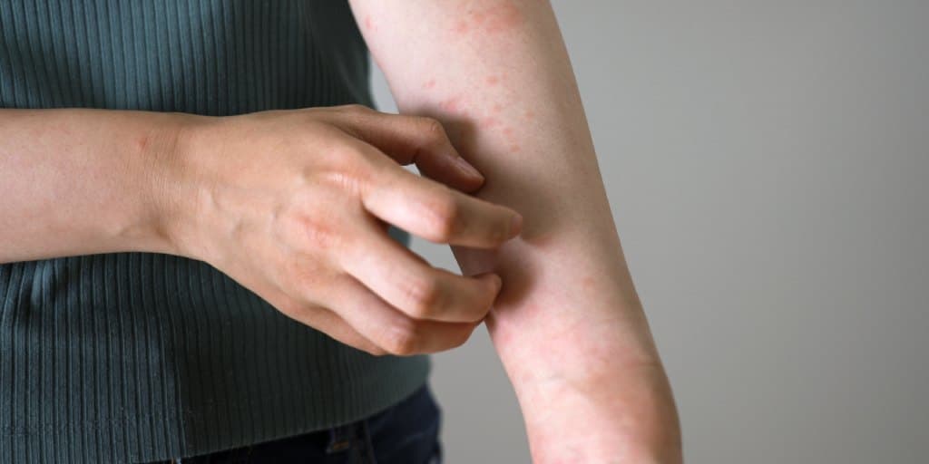 dieta przy łuszczycy